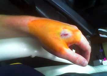 RFID chip implanted in hand.